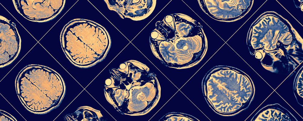 Brain scans from multiples angles.
